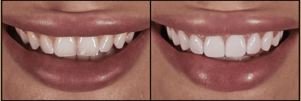 Qué es mejor carillas dentales o blanqueamiento dental Institut